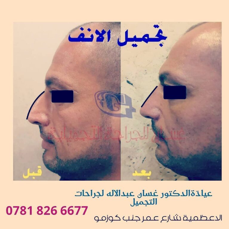 تجميل الانف 768x768