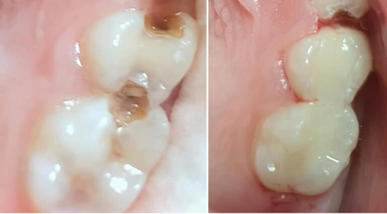 تجميل الحشوات الضوئيه 768x426