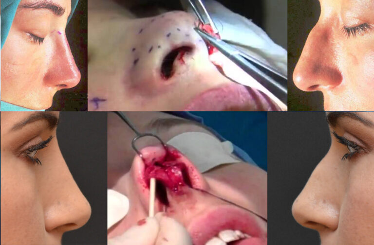 تجميل انف 1 768x504