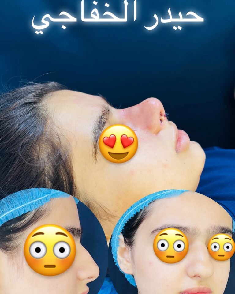 تجميل انف 2 768x960