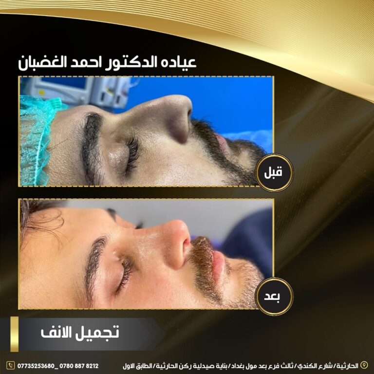 تجميل انف 768x768