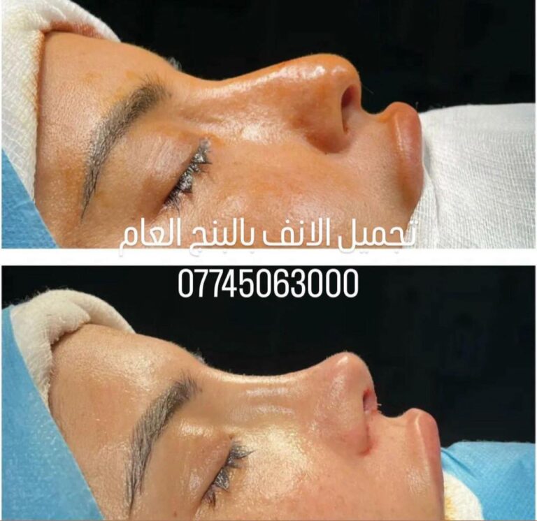 تجميل انف بالبنج 768x746