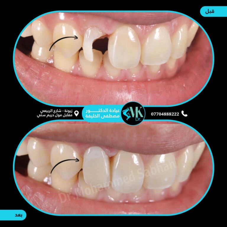 تجميل حشوه 768x768