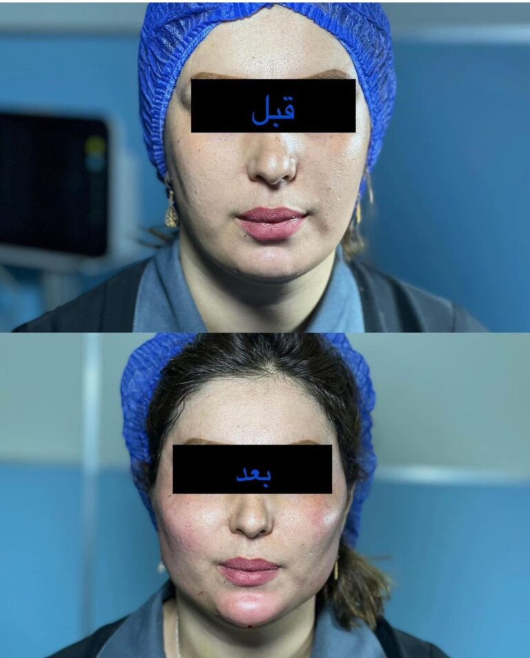 تجميل شفاه 768x953