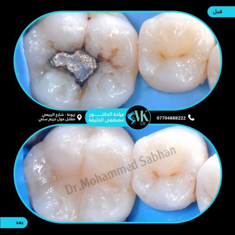 تخلص من المعدن 768x768