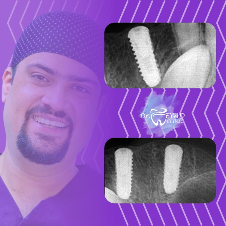 تركيب اسنان 768x768