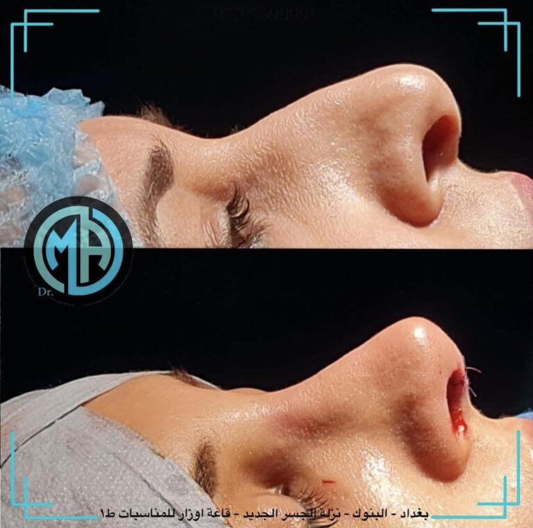 ترميم الانف 768x761