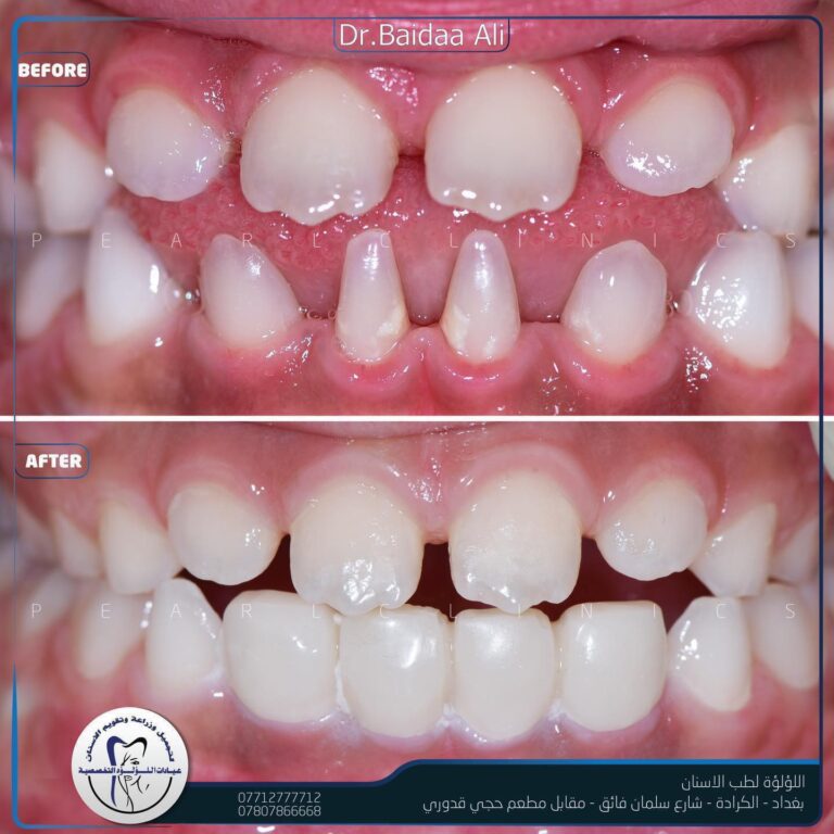 تشوهات الاسنان الخلقيه 768x768