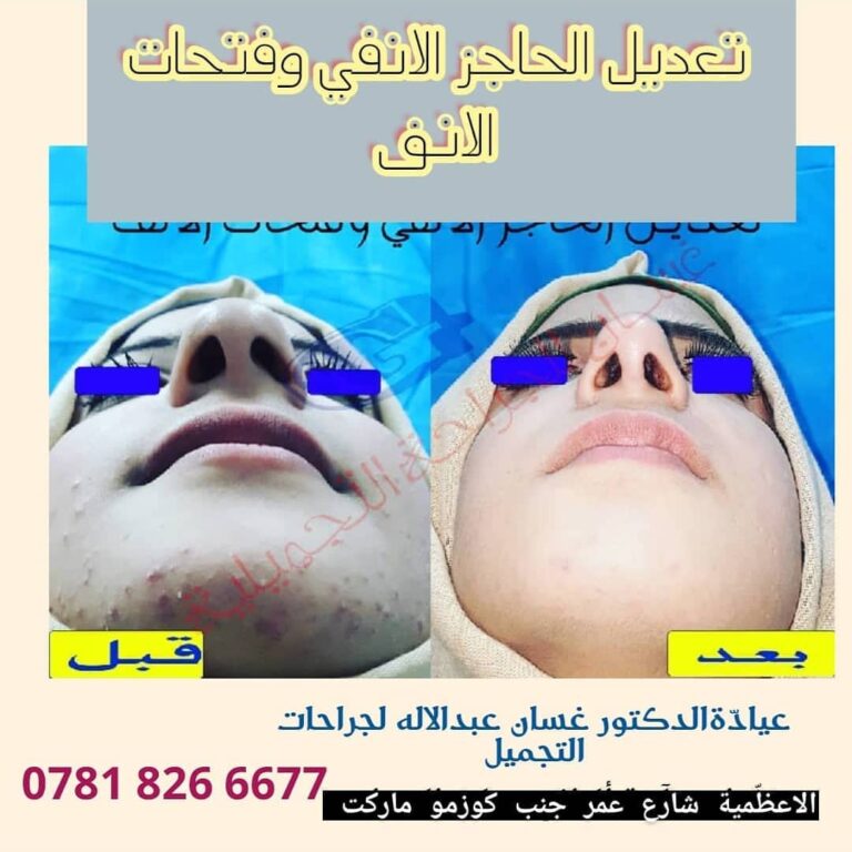 تعديل الحاجز الانفي 768x768