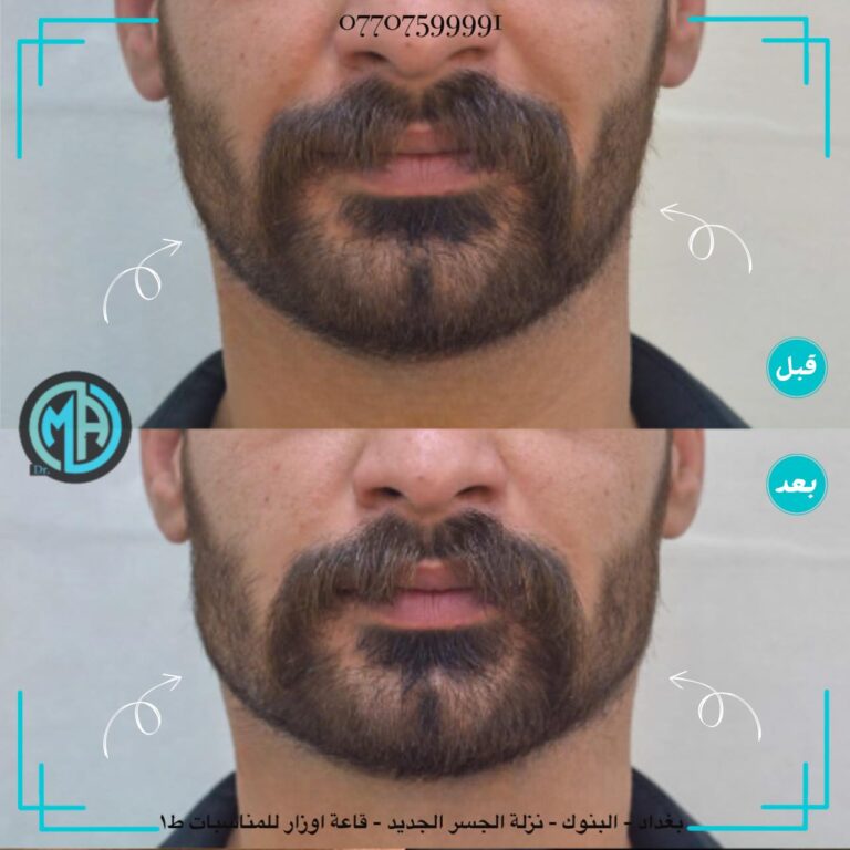 تعريض الفك 768x768