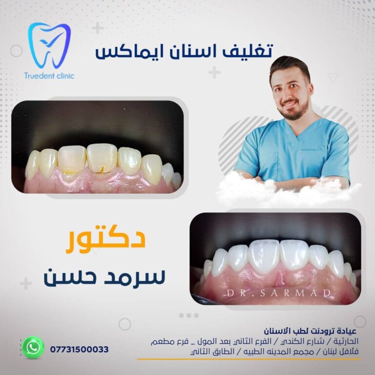 تغليف اسنان 768x768
