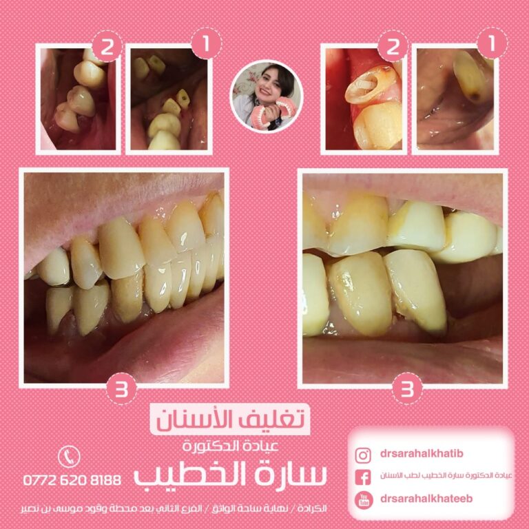 تغليف الاسنان 768x768