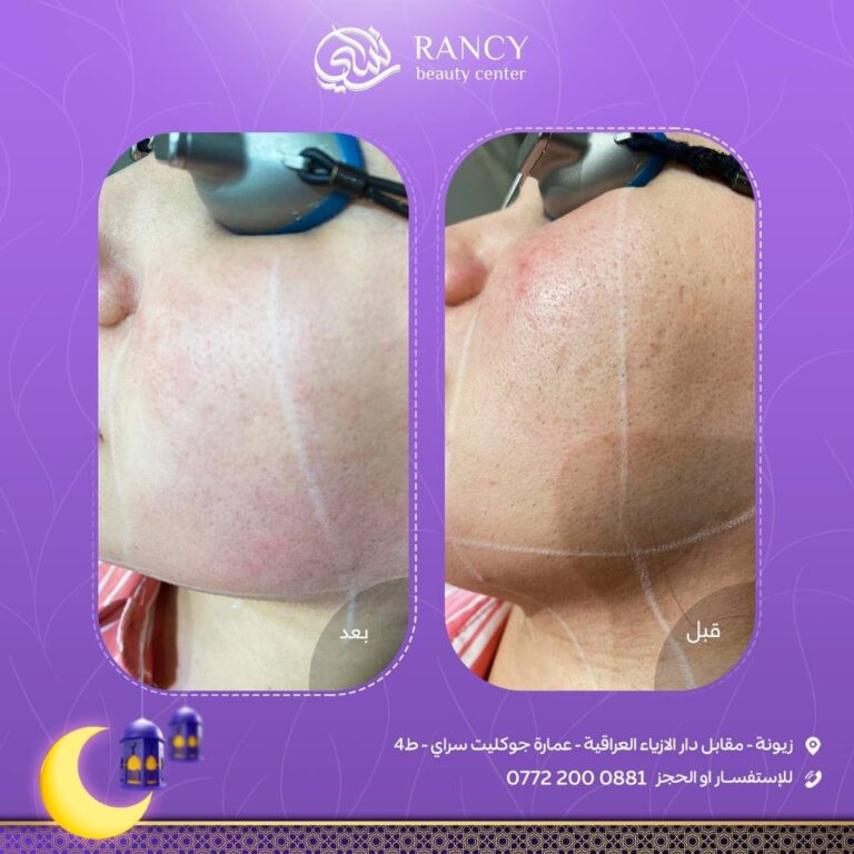 تفتيح البشره 768x768