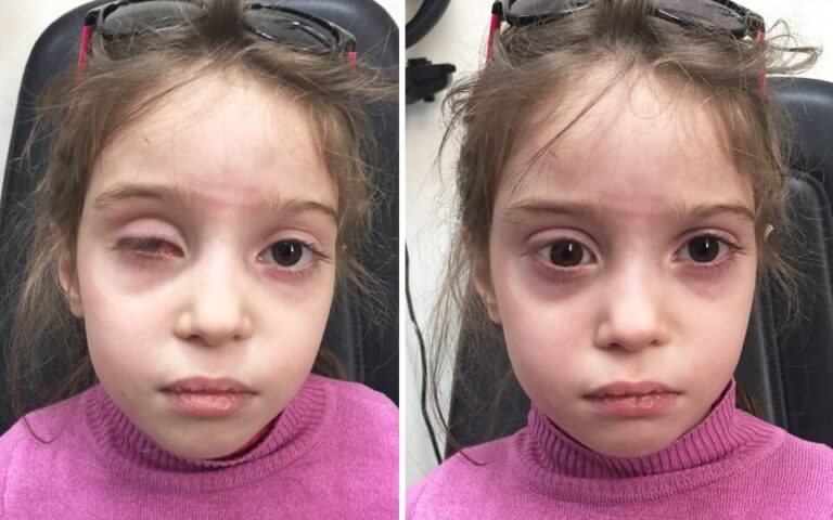 تفريغ للعين وتركيب عين اصطناعيه 768x480