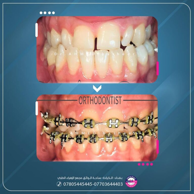 تقويم اسنان 768x768