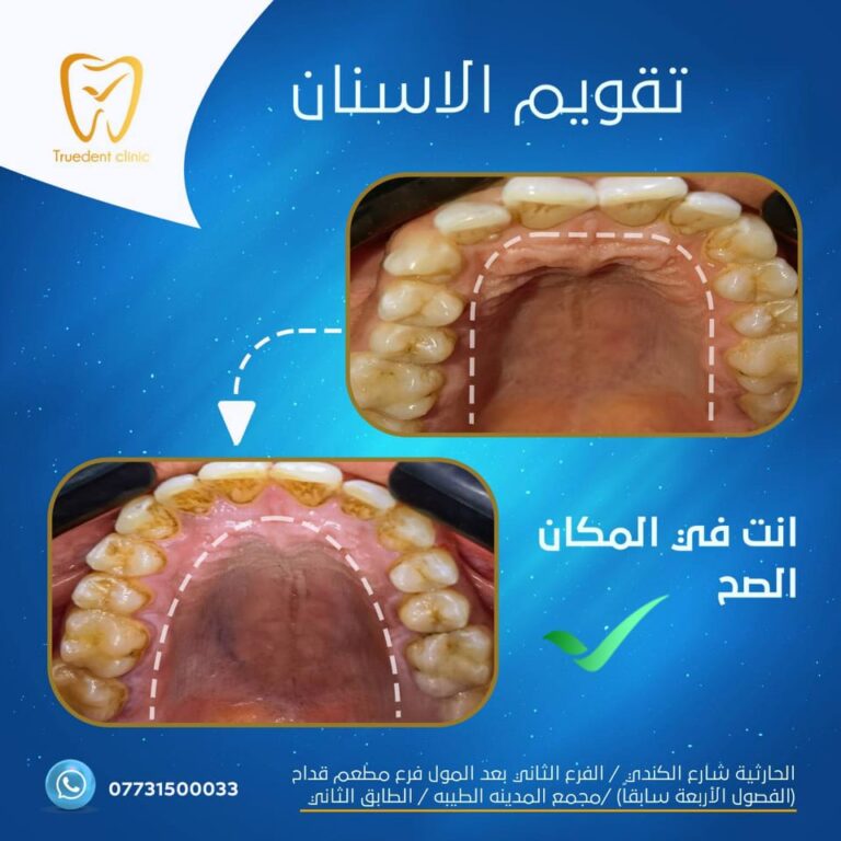 تقويم اسنان 768x768