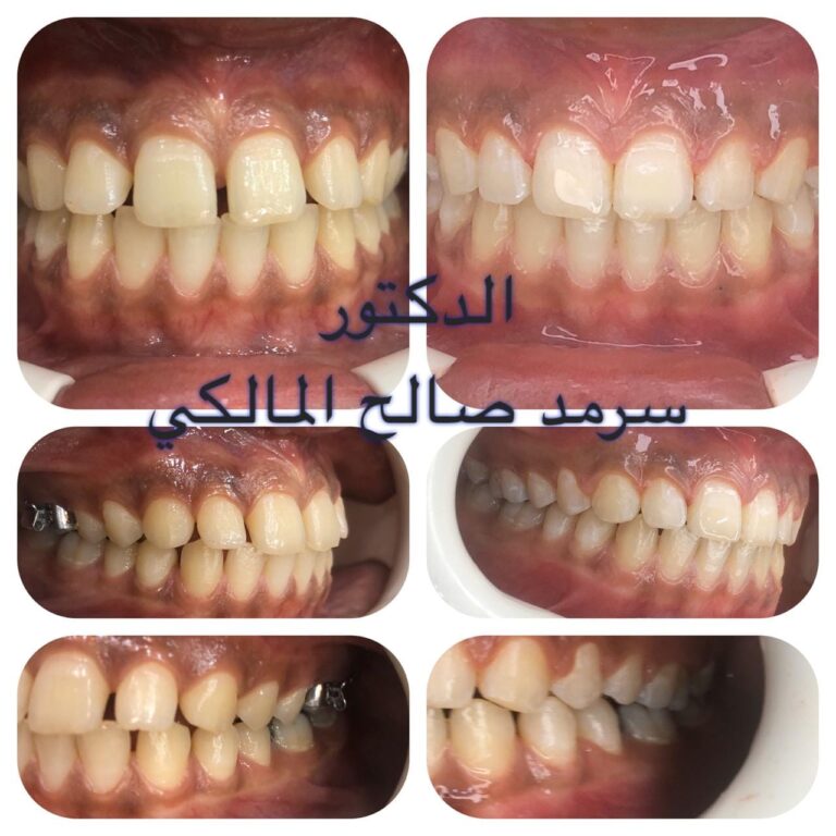تقويم الاسنان 1 1 768x768