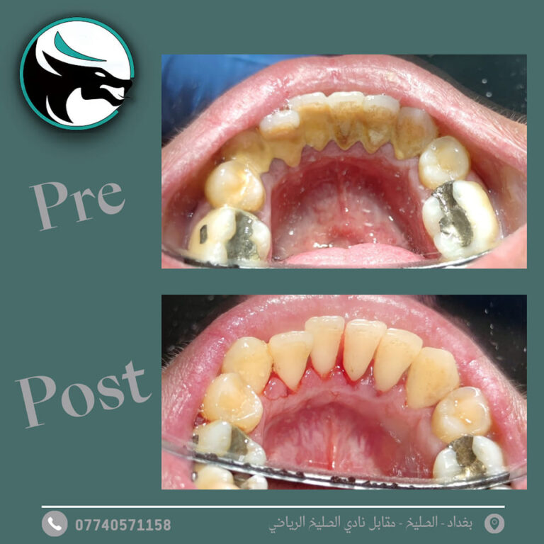 تكلس الاسنان 768x768