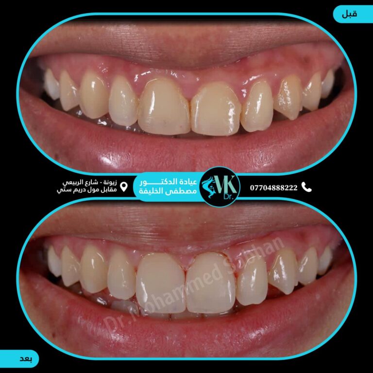 تنضيف الاسنان 1 768x768
