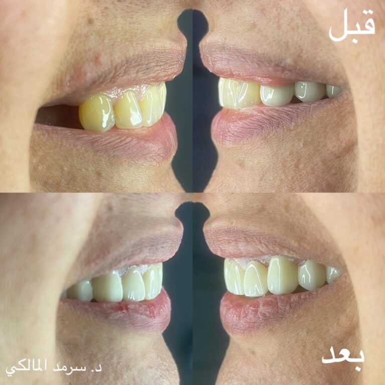 تنضيف الاسنان 2 768x768