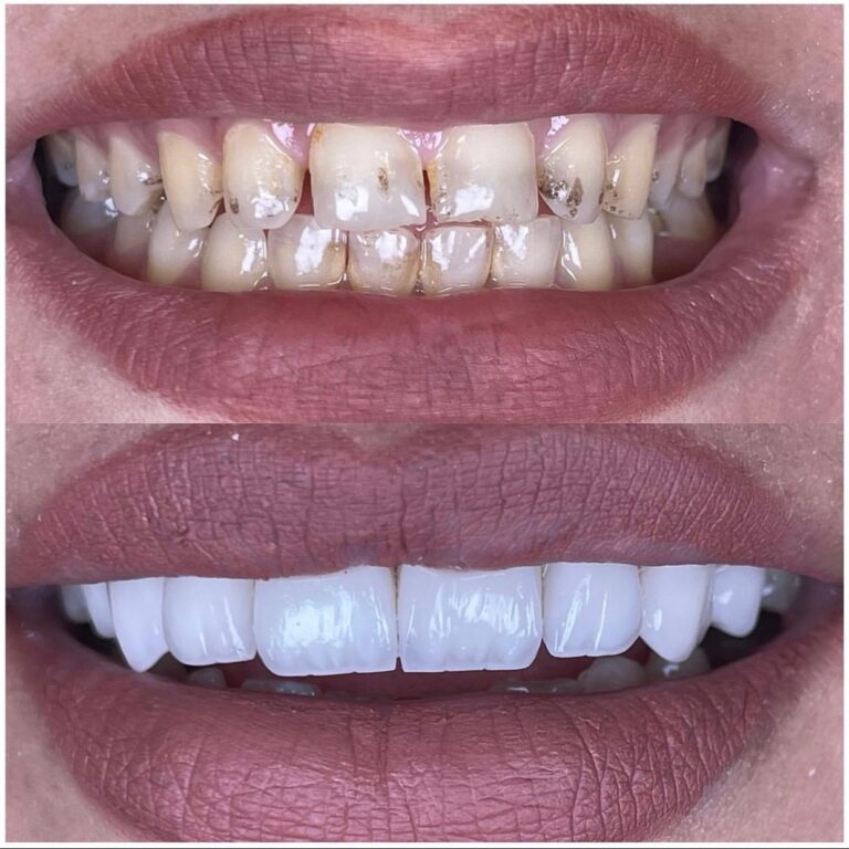 تنضيف الاسنان 768x768