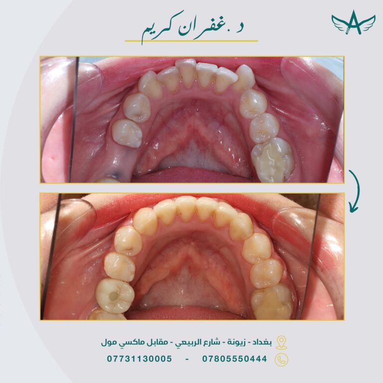 تنظبف وتجميل الاسنان 768x768