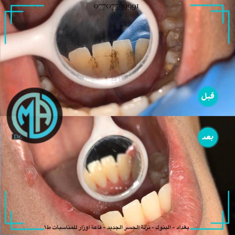 تنظيف اسنان 1 768x768