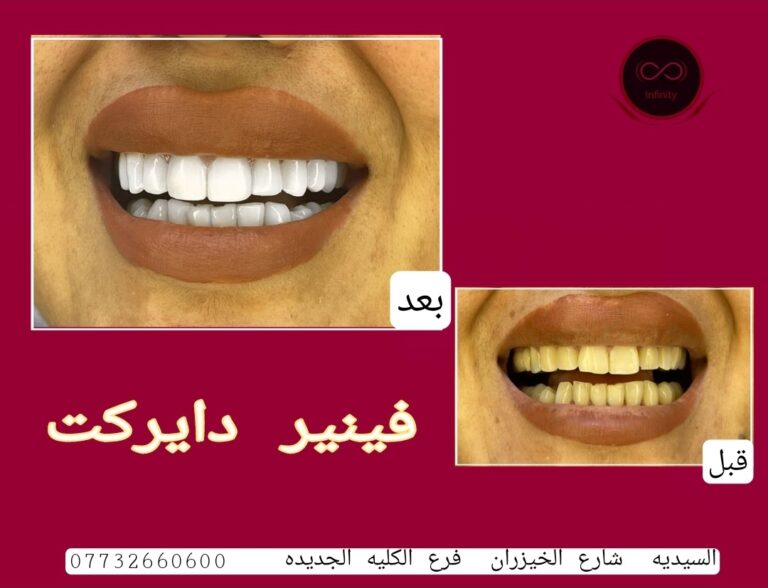 تنظيف الاسنان 1 768x588
