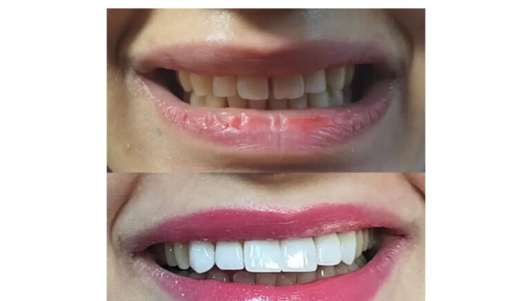 تنظيف الاسنان 3 768x435