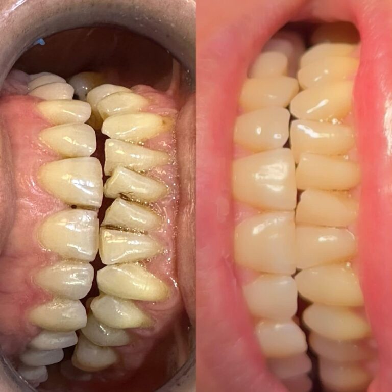 تنظيف وتلميع الاسنان 768x768