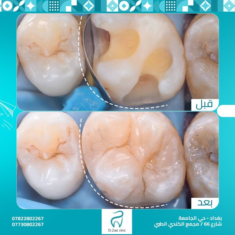 حشوات 1 768x768