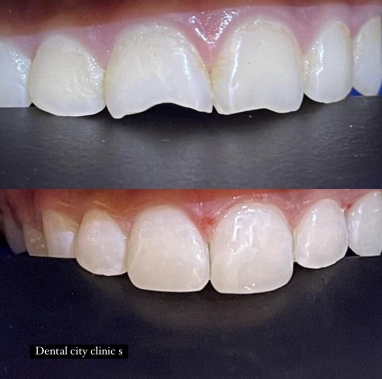 حشوات اسنان 768x762