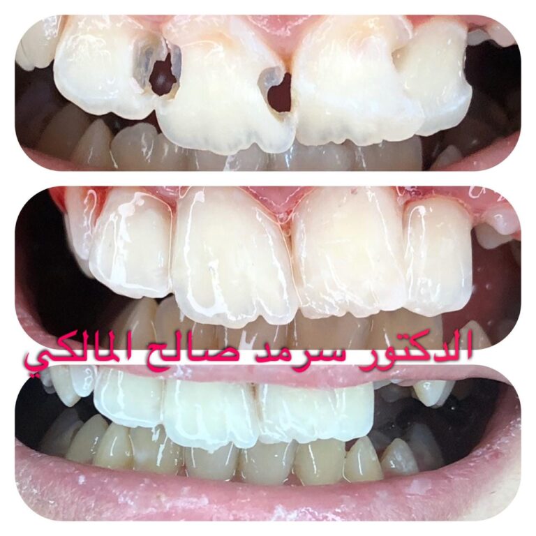 حشوات اسنان اماميه 768x768