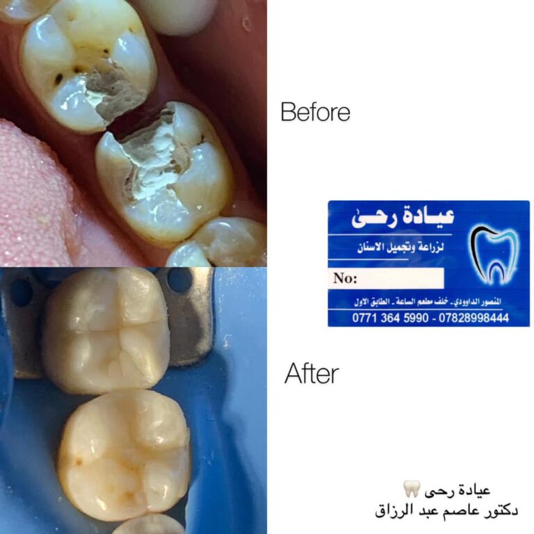 حشوات تجميل 4 768x768