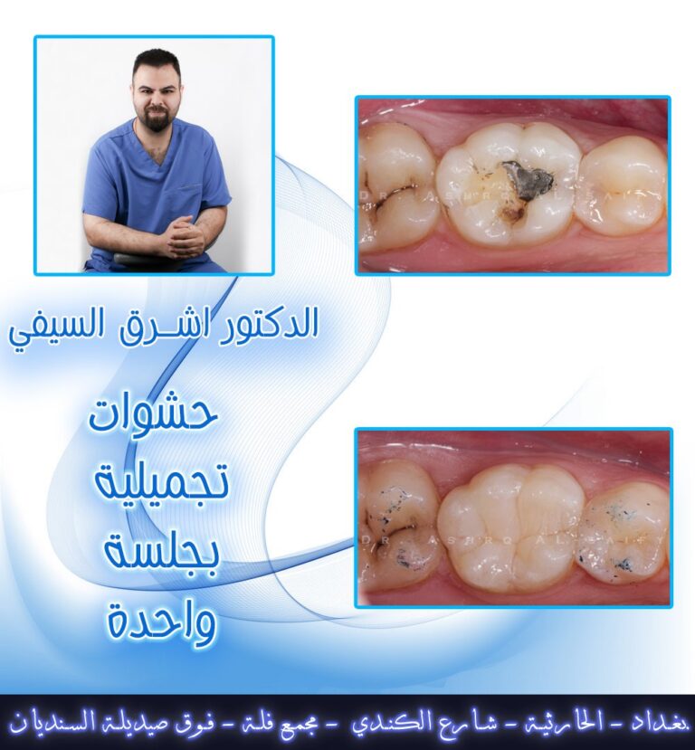 حشوات تجميليه 1 768x829