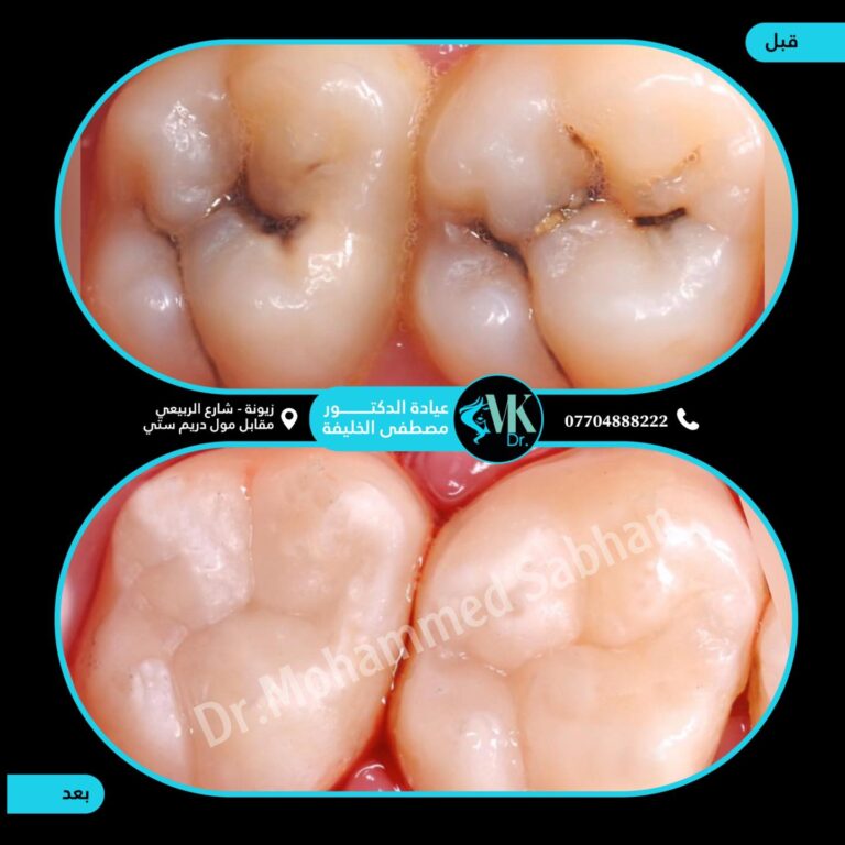 حشوات تجميليه 768x768