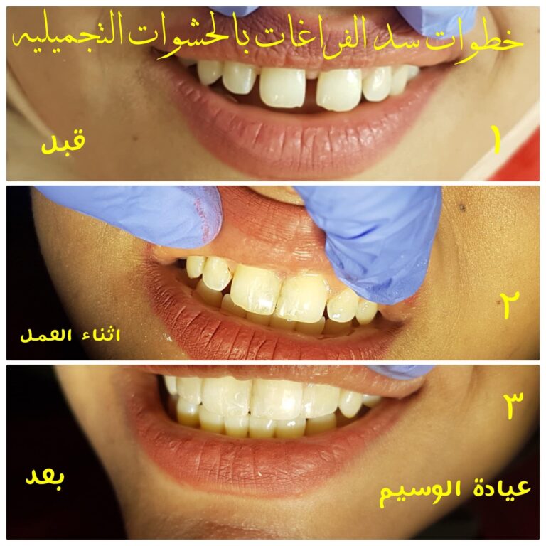 حشوات سد الفراغات 768x768