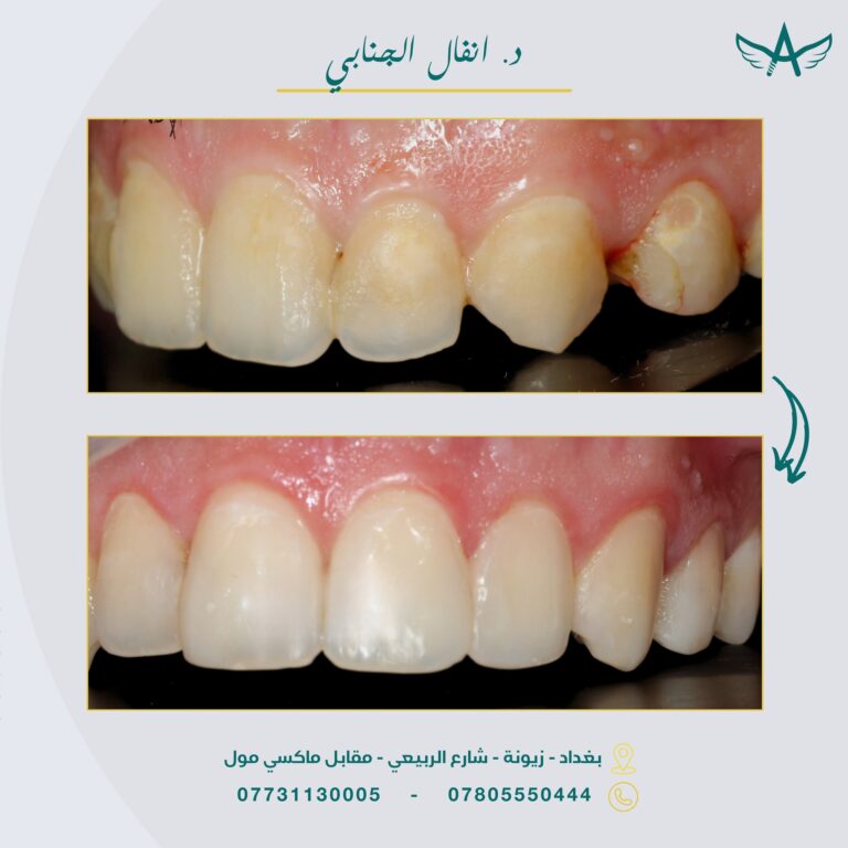 حشوة الاسنان 768x768