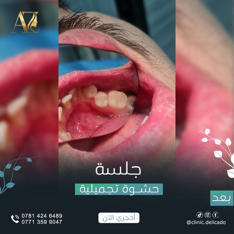 حشوه تجميل 1 768x768