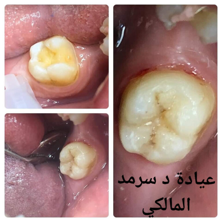 حشوه تجميل 768x768