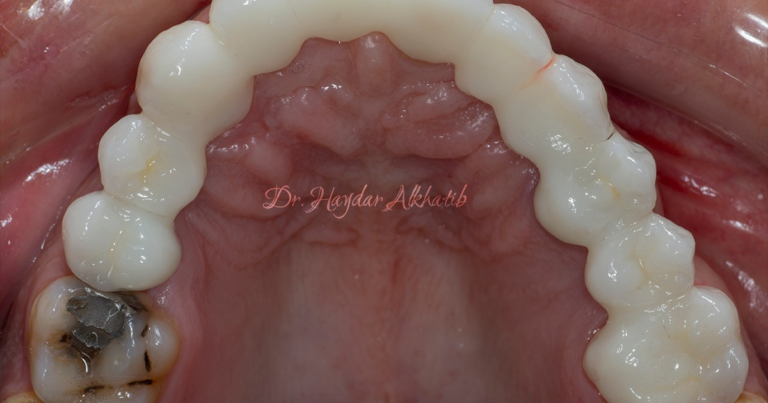 حشوه تجميليه 768x403