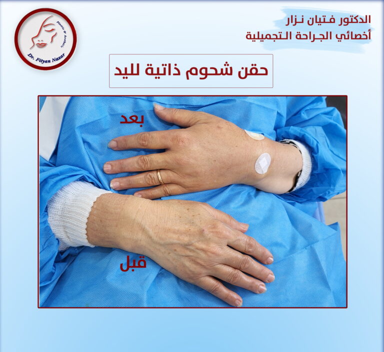 حق شحوم اليدين 768x705