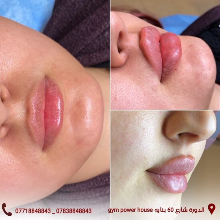 حق فلر شفاه 768x768