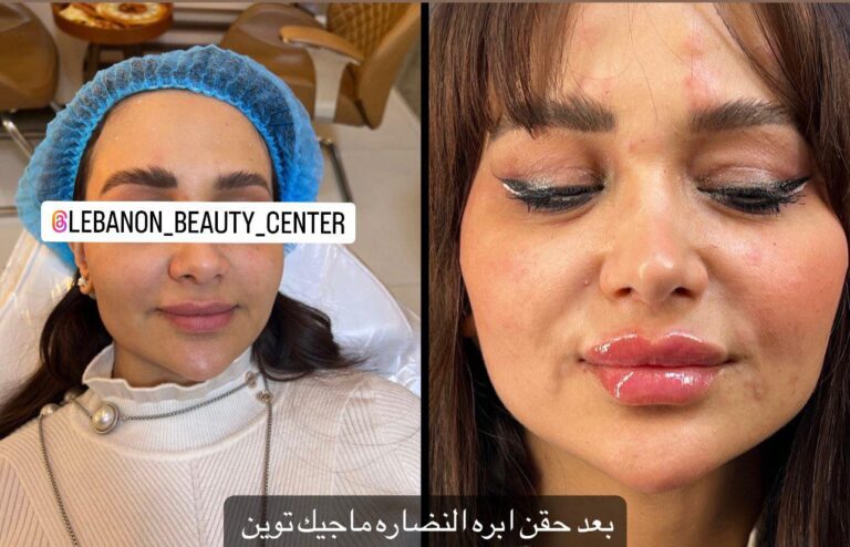 حقن ابره النضاره 768x494