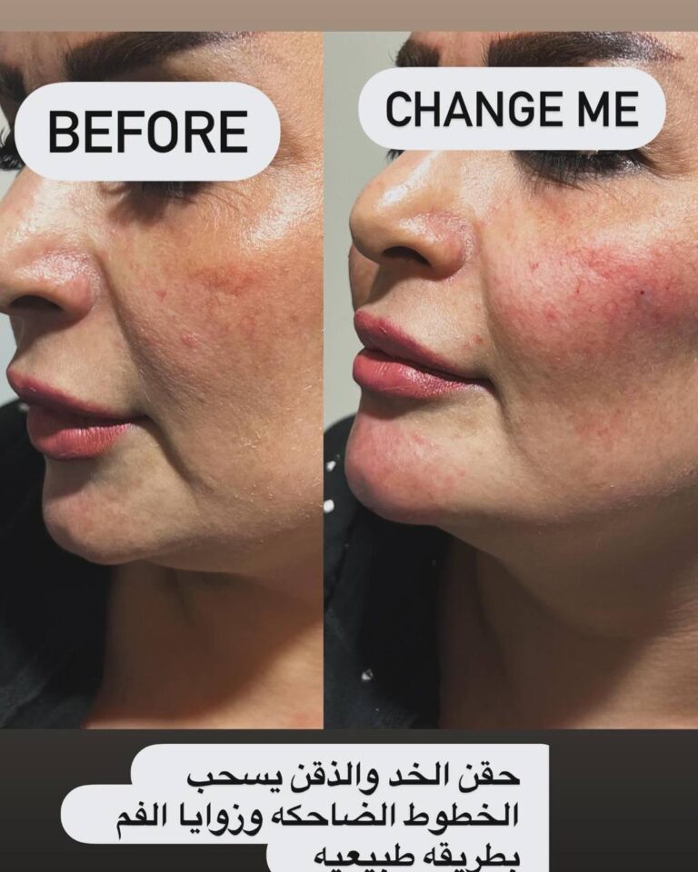 حقن الخد 768x960