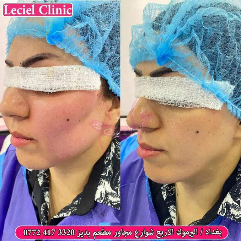 حقن الشحوم 768x768