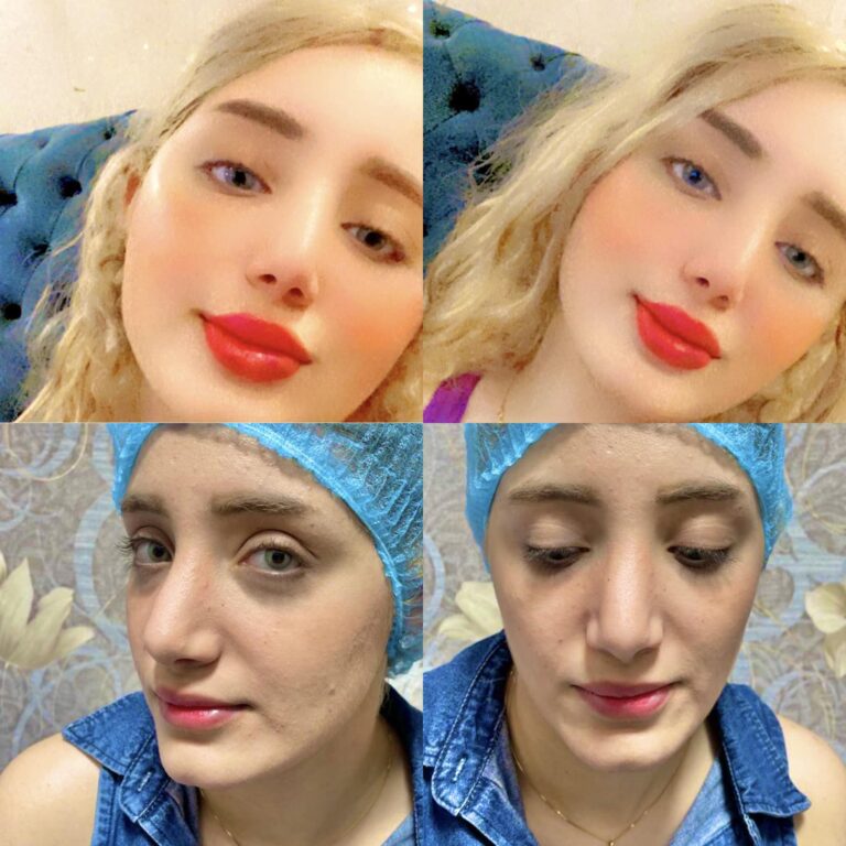 حقن الشحوم الذاتيه 768x768