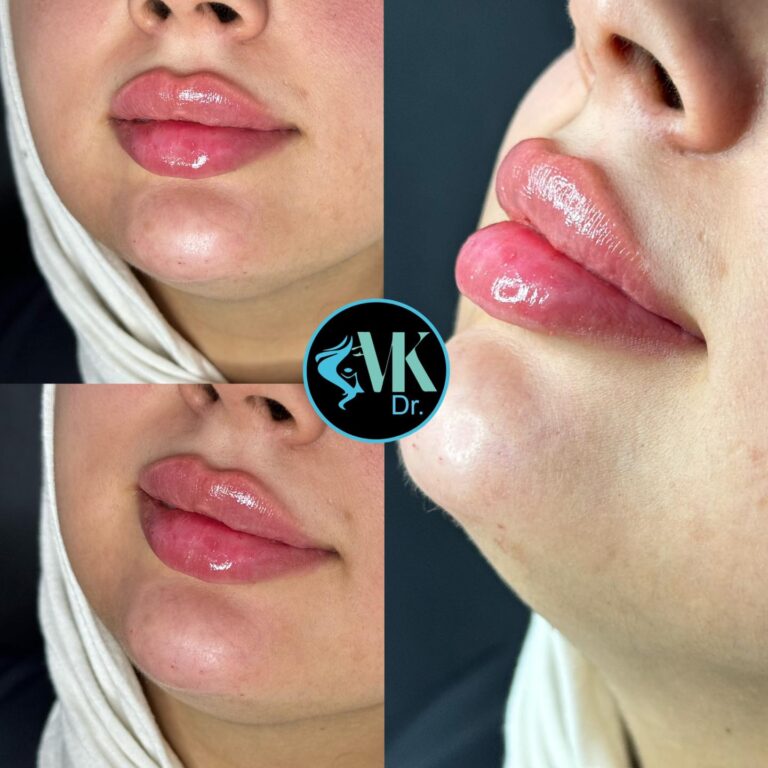 حقن الشفاه 768x768