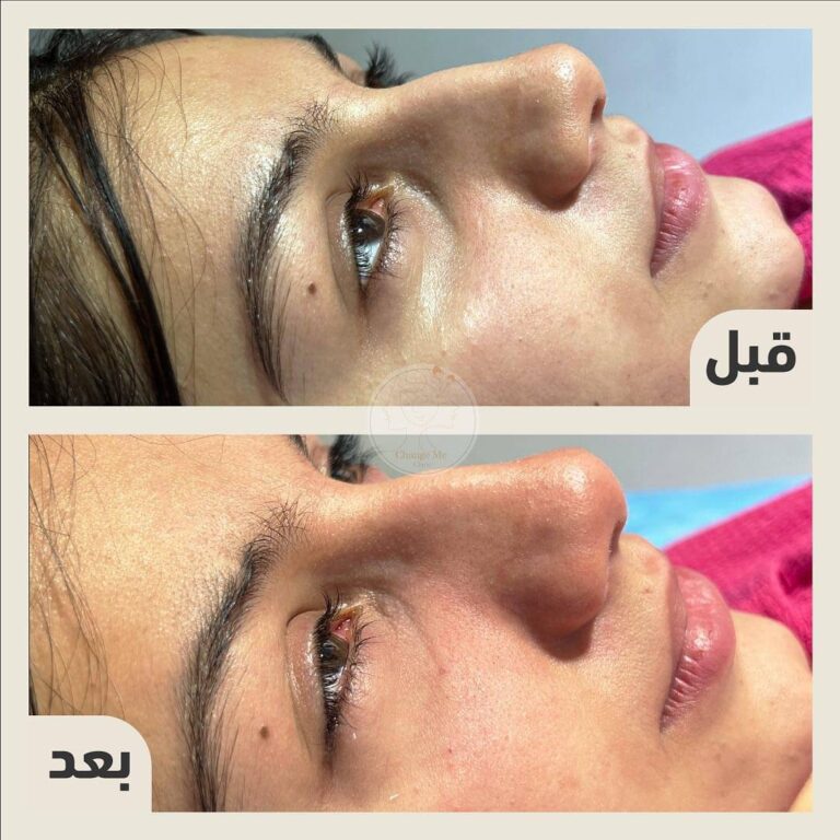 حقن تحت العين 768x768