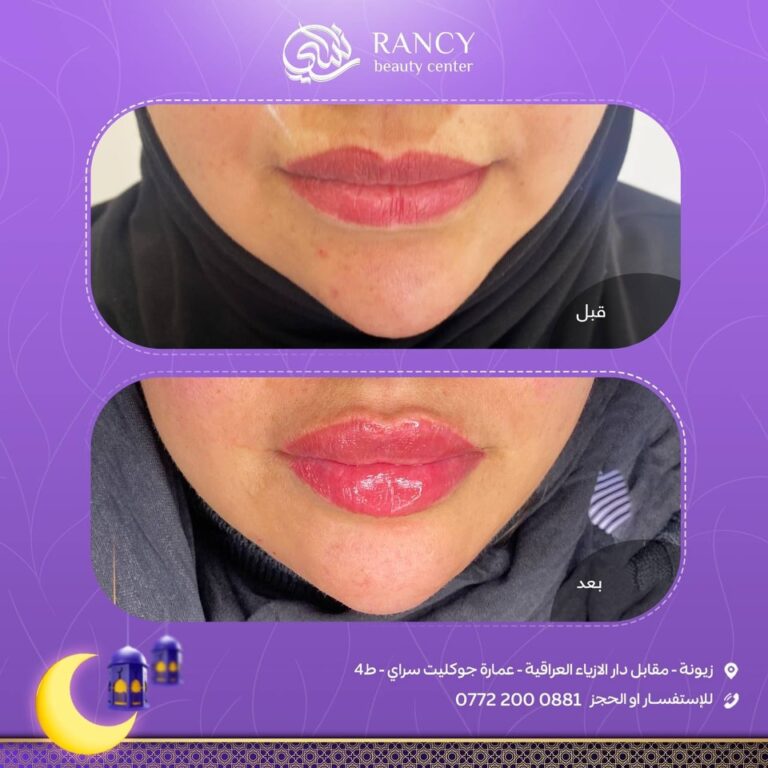 حقن ذقن وشفه 768x768